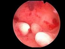 2026年单身女人去阳泉市做试管生孩子贵吗？费用详细介绍